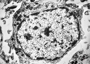 F,12y. | oligodendroglioma